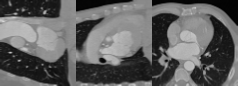 Generated Sequence of Myocardium Deformation